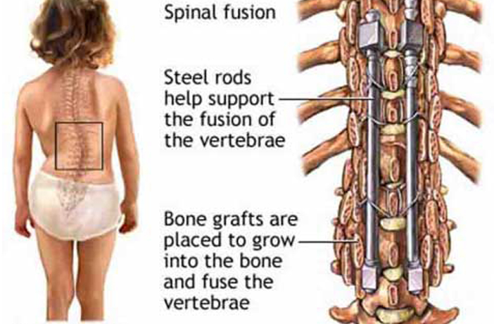 Spine surgey