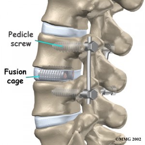 Spine Surgery Minimal Access